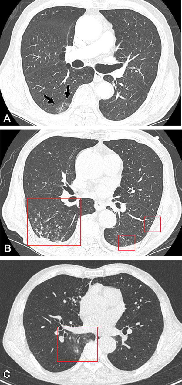 Cases of SARS-CoV-2 reinfection and breakthrough infection during an Omicron BA.5 subvariant–predominant period. (A, B) CT scans (lung window) in an 82-year-old man with COVID-19 reinfection during an Omicron BA.5 subvariant predominant period. The patient had a history of prior Omicron BA.1 subvariant infection and cerebrovascular accident. (A) Transverse nonenhanced CT scan obtained at bronchus intermedius level at the time of Omicron BA.1 subvariant (his first infection) shows focal area of ground-glass opacity (GGO) in superior segment of right lower lobe (arrows). CT findings were classified as “indeterminate” according to the RSNA chest CT classification system. (B) Transverse nonenhanced CT scan obtained at the level of basal trunks at the time of reinfection of Omicron BA.5 subvariant 4 months after the first infection shows poorly defined centrilobular nodules in the dependent portions of bilateral lower lobes (squares). CT findings were classified as “atypical” according to the RSNA chest CT classification system. (C) CT scan (lung window) of breakthrough infection of SARS-CoV-2 during an Omicron BA.1 subvariant–dominant period in a 76-year-old man with a history of hypertension and pulmonary tuberculosis who had received his COVID-19 booster. Transverse nonenhanced CT scan obtained at level of inferior pulmonary vein shows focal area of poorly defined GGO (square) in the right lower lobe. CT findings were classified as “indeterminate” according to the RSNA chest CT classification system.