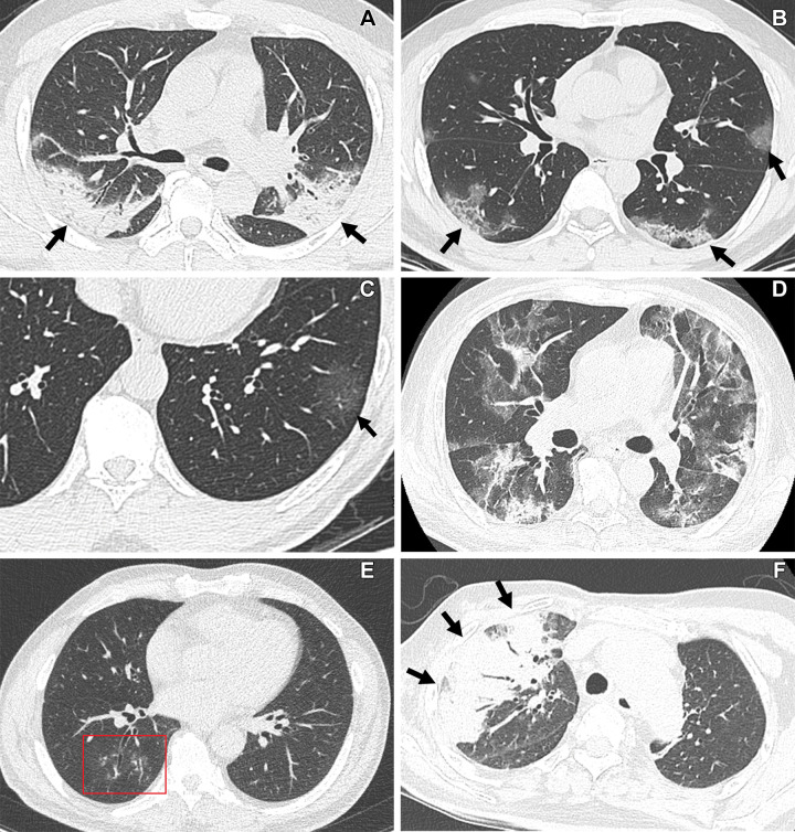 CT findings of COVID-19 pneumonia according to RSNA CT classification schemes. (A, B) “Typical” COVID-19 pneumonia according to the RSNA chest CT classification system. (A) Transverse nonenhanced CT scan (lung window) obtained in a 48-year-old unvaccinated man with a history of hypertension and diabetes seen at the wild type–dominant period shows bilateral areas of consolidation with peripheral distribution (arrows). (B) Transverse nonenhanced CT scan (lung window) obtained in a 40-year-old unvaccinated man with no underlying disease seen at the wild type–dominant period shows patchy areas of mixed ground-glass opacity (GGO) and consolidation with subpleural distribution (arrows). (C, D) “Indeterminate” COVID-19 pneumonia according to the RSNA chest CT classification system. (C) Transverse nonenhanced CT scan (lung window) obtained in a 61-year-old unvaccinated woman with no underlying disease seen at the wild type–dominant period shows focal area of GGO (arrow) in left lower lobe. (D) Transverse nonenhanced CT scan (lung window) obtained in a 65-year-old fully vaccinated man with hypertension, diabetes, and a history of renal transplant seen at the Delta variant–dominant period shows extensive areas of mixed GGO and consolidation without zonal predominance. (E, F) “Atypical” COVID-19 pneumonia according to the RSNA chest CT classification system. (E) Transverse nonenhanced CT scan (lung window) obtained in a 42-year-old woman who received a booster dose with no underlying disease seen at Omicron variant–dominant period shows poorly defined small nodules (box) with peribronchial distribution in the right lower lobe. (F) Transverse nonenhanced CT scan (lung window) obtained in a 68-year-old unvaccinated man with history of cerebrovascular accident seen at Omicron variant–dominant period shows segmental area of consolidation (arrows) with air bronchogram in the right upper lobe.