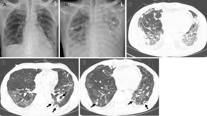 COVID-19 pneumonia during an Omicron BA.5 subvariant–predominant period in a 58-year-old man with a history of lung transplant for idiopathic pulmonary fibrosis who had received a booster dose of vaccine. (A) Chest radiograph obtained 7 days after positive nucleic acid amplification test for COVID-19 shows parenchymal opacity involving peripheral portion of both lower lungs. (B) Follow-up chest radiograph obtained 2 days after the initial chest radiograph demonstrates increased parenchymal opacity and extensive consolidation in the lungs. (C) Transverse nonenhanced CT scan (lung window) obtained at the level of segmental bronchi of both lower lobes 9 days after SARS-CoV-2 infection demonstrates extensive areas of mixed ground-glass opacity (GGO) and consolidation, with a peripheral predominance. (D, E) Follow-up transverse nonenhanced CT scans (lung window) obtained at levels of inferior pulmonary veins (D) and segmental bronchi of both lower lobes (E) 3 weeks after SARS-CoV-2 infection demonstrate decreased extent of GGO and consolidation, but multiple nodules (arrows) with or without cavity are scattered in bilateral lungs. Galactomannan antigen test for Aspergillus was positive at this time. The patient died with acute respiratory distress syndrome.