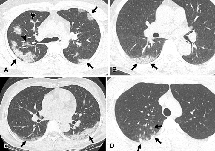 COVID-19 pneumonia during Delta variant– and Omicron variant–dominant periods. (A, B) Images of COVID-19 pneumonia at Delta variant–dominant period. (A) Transverse nonenhanced CT scan (lung window) obtained in a 34-year-old unvaccinated man with no underlying disease shows multifocal areas of mixed ground-glass opacity (GGO) and consolidation with subpleural (arrows) and peribronchial (arrowheads) distribution. CT findings were classified as “typical” according to the RSNA chest CT classification system. (B) Transverse nonenhanced CT scan (lung window) obtained in a 58-year-old fully vaccinated man with no underlying disease seen at Delta variant–dominant period shows a focal subpleural area of consolidation (arrows) in superior segment of right lower lobe. This case was classified as “indeterminate” according to the RSNA chest CT classification system. (C, D) COVID-19 pneumonia at Omicron variant–dominant period. (C) Transverse nonenhanced CT scan (lung window) obtained in 56-year-old unvaccinated woman with no underlying disease shows subpleural areas of mixed GGO and consolidation (arrows) in both lower lobes. CT findings were classified as “typical” according to the RSNA chest CT classification system. (D) Transverse nonenhanced CT scan (lung window) obtained in a 20-year-old man with no underlying disease who received a booster dose shows poorly defined centrilobular nodules in the right upper lobe (arrows). This case was considered “atypical” according to the RSNA chest CT classification system.