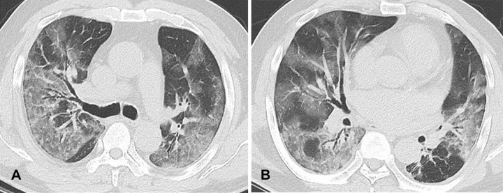 COVID-19 pneumonia with diffuse alveolar damage pattern in a 64-year-old unvaccinated man with no underlying disease at Delta variant–dominant period. (A, B) Follow-up transverse nonenhanced CT scans (lung window) obtained at levels of right main bronchus (A) and right middle lobar bronchus (B) 1 day after positive nucleic acid amplification test for COVID-19 demonstrate extensive areas of ground-glass opacity involving bilateral lungs.