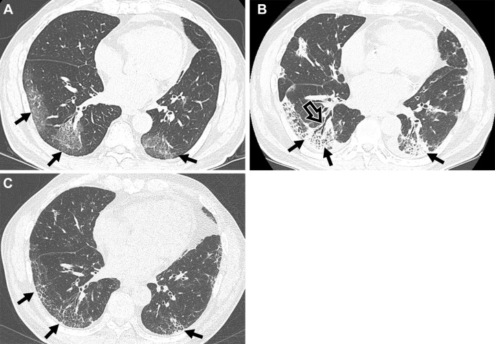 Serial images in a 72-year-old man with COVID-19 pneumonia. (A) Transverse nonenhanced CT scan (lung window) obtained at inferior pulmonary vein level 1 week after SARS-CoV-2 infection shows lower lobe–predominant patchy areas of ground-glass opacity (GGO) in bilateral lungs (arrows). (B) Transverse nonenhanced CT scan (lung window) obtained at inferior pulmonary vein level 1 month after SARS-CoV-2 infection shows lower lobe–predominant patchy areas of consolidation (solid arrows) in bilateral lungs. Note bronchial dilatation (open arrow) within the consolidation. (C) Transverse nonenhanced CT scan (lung window) obtained 6 months after infection demonstrates residual reticulations (arrows) and GGOs.