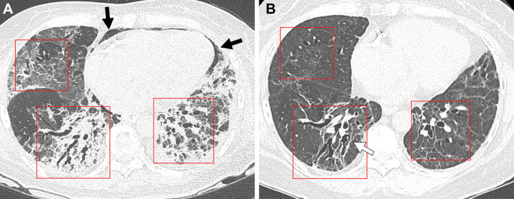 Serial images in a 64-year-old woman with COVID-19 pneumonia. (A) Transverse nonenhanced CT scan (lung window) obtained at ventricular level 1 month after SARS-CoV-2 infection shows lower lobe–predominant patchy and wide areas of mixed consolidation and ground-glass opacity (GGO) in bilateral lungs. Note areas of bronchial dilatation (boxes) within parenchymal lesions. Pneumomediastinum (arrows) is also present anteriorly. (B) Transverse nonenhanced CT scan (lung window) obtained 12 months after infection demonstrates dilated bronchi (boxes) within remaining GGO lesions. Linear parenchymal bands (arrow) are also noted.