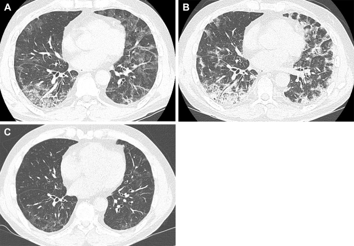 Serial images in a 55-year-old man with COVID-19 pneumonia. (A) Transverse nonenhanced CT scan (lung window) obtained at levels of basal segmental bronchi 4 weeks after SARS-CoV-2 infection shows extensive and patchy areas of mixed ground-glass opacity (GGO) and consolidation in bilateral lungs. (B) Transverse nonenhanced CT scan (lung window) obtained 5 weeks after infection demonstrates increased density of GGO lesions with consolidation. (C) Transverse nonenhanced CT scan (lung window) obtained 9 months after infection demonstrates residual faint GGO and reticulations.