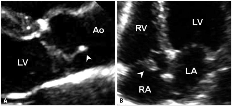 Anatomic Variants Mimicking Pathology on Echocardiography: Differential ...