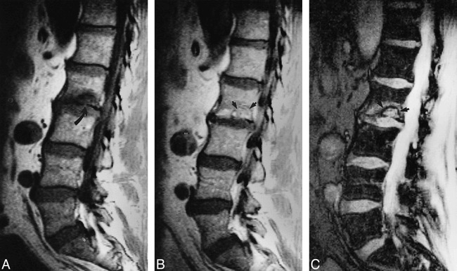 Relationship of Schmorl's Nodes to Vertebral Body Endplate Fractures ...