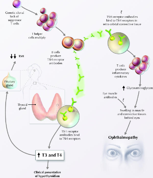 Diagnosis and management of Graves' disease - PMC
