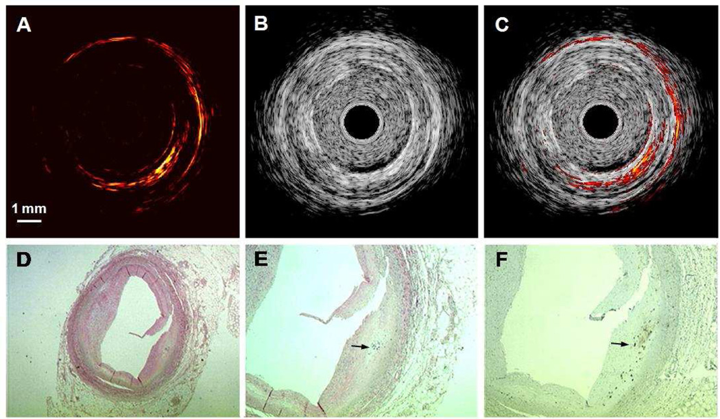 In Vivo Intravascular Ultrasound-guided Photoacoustic Imaging Of Lipid 