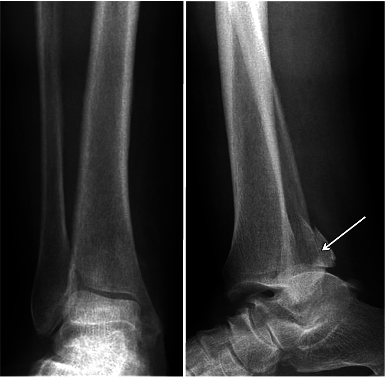 Bosworth ankle fracture-dislocation: current concept review - PMC