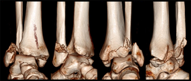 Bosworth ankle fracture-dislocation: current concept review - PMC