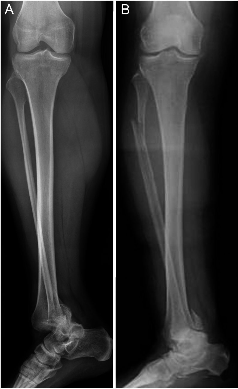 Bosworth ankle fracture-dislocation: current concept review - PMC