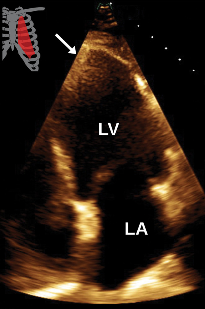 Apical thrombus in an 81-year-old man with a history of coronary artery disease and prior myocardial infarction. (a) Axial SSFP MR image shows a flat hypointensity (arrow) in an otherwise morphologically normal LV. (b) Apical two-chamber TTE view obtained 1 day earlier shows a questionable area of hyperechogenicity (arrow) near the LV apex, without a definite apical thrombus visualized.