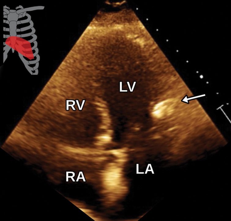 Pericardial calcifications in a 57-year-old man with chronic orthopnea and dyspnea, suggestive of constrictive pericarditis. (a, b) Axial (a) and coronal (b) cardiac CTA images of the chest show pericardial calcifications, most notable along the RV (arrow) and adjacent to the mitral valve (arrowhead in a). (c) Apical four-chamber TTE view shows a hyperechoic lesion (arrow) adjacent to the mitral valve, which was seen only in retrospect. The echogenic appearance is most consistent with calcification, although prominent fat in the atrioventricular groove can have a similar appearance. The true extent of pericardial calcification is visualized much better at CT.