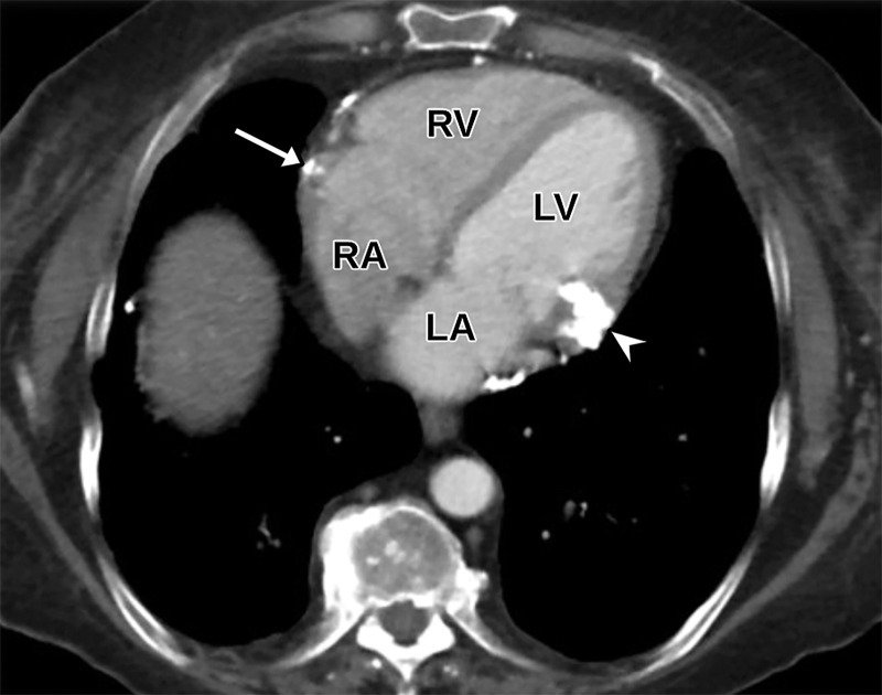Pericardial calcifications in a 57-year-old man with chronic orthopnea and dyspnea, suggestive of constrictive pericarditis. (a, b) Axial (a) and coronal (b) cardiac CTA images of the chest show pericardial calcifications, most notable along the RV (arrow) and adjacent to the mitral valve (arrowhead in a). (c) Apical four-chamber TTE view shows a hyperechoic lesion (arrow) adjacent to the mitral valve, which was seen only in retrospect. The echogenic appearance is most consistent with calcification, although prominent fat in the atrioventricular groove can have a similar appearance. The true extent of pericardial calcification is visualized much better at CT.