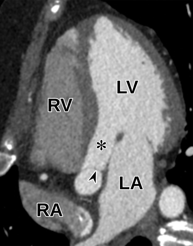 Normal apical five-chamber view at TTE (a) and correlative cardiac CTA (b). Arrowhead = aortic valve, * = LV outflow tract.