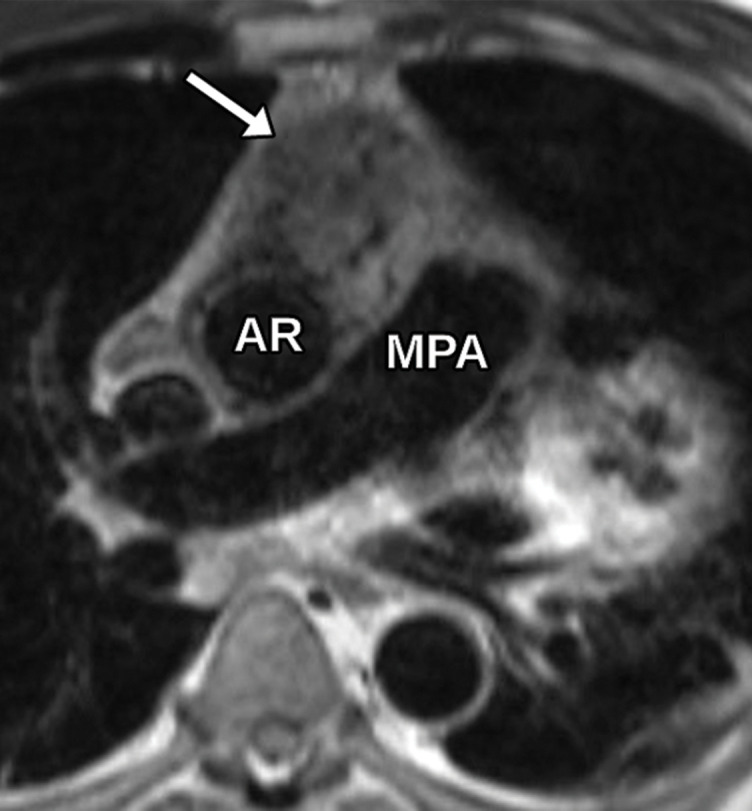 Anterior mediastinal mass. (a) Axial contrast-enhanced T1-weighted MR image shows a large avidly enhancing anterior mediastinal mass (arrow) with displacement of the heart secondary to mass effect. (b) Axial T2-weighted black-blood MR image shows the anterior mediastinal mass (arrow) with prominent internal hypointense flow voids. AR = aortic root, MPA = main pulmonary artery. (c, d) Axial (c) and sagittal (d) CTA images show the avidly enhancing anterior mediastinal mass (arrow) with an associated pericardial effusion (*). AR = aortic root, MPA in c = main pulmonary artery, RPA in d = right pulmonary artery. (e) Digital sub traction angiogram shows prominent contrast blush in the region of the mass (arrow) near the right coronary artery (arrowhead). (f) Parasternal long-axis TTE view retrospectively shows but incompletely characterizes the large anterior mediastinal mass (arrowhead), which is partially seen as a complex heterogeneous hypoechoic mass in the lateral aspect of the field of view. LVOT = LV outflow tract. Surgical biopsy yielded histologic findings consistent with a paraganglioma.