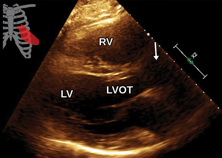 Aortic dissection in a 71-year-old man with a medical history significant for hypertension who presented to the emergency department (ED) with severe acute back pain. (a) Axial CTA image of the aorta shows an aortic dissection involving the aortic root and descending aorta (arrows) with extension to the large branch vessels (not shown). (b) Parasternal long-axis TTE view obtained earlier in the ED shows no gross abnormality. In particular, there is no dissection flap identified in the aortic root (arrow). LVOT = LV outflow tract.