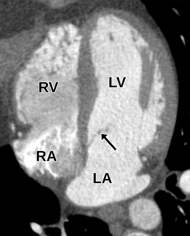 Normal apical four-chamber view at TTE (a) and correlative cardiac CTA (b). Owing to the parallel orientation of the interatrial septum to the ultra-sound beam, an atrial septal defect may be simulated where no actual defect is present. Additionally, valve leaflets may be difficult to visualize on cardiac CTA images. Straight arrow = mitral valve, curved arrow = tricuspid valve.