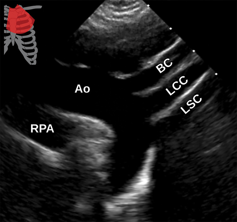 Normal suprasternal long-axis view at TTE (a) and correlative cardiac CTA (b). Ao = aorta, BC = brachiocephalic artery, LCC = left common carotid artery, LSC = left subclavian artery, RPA = right pulmonary artery.