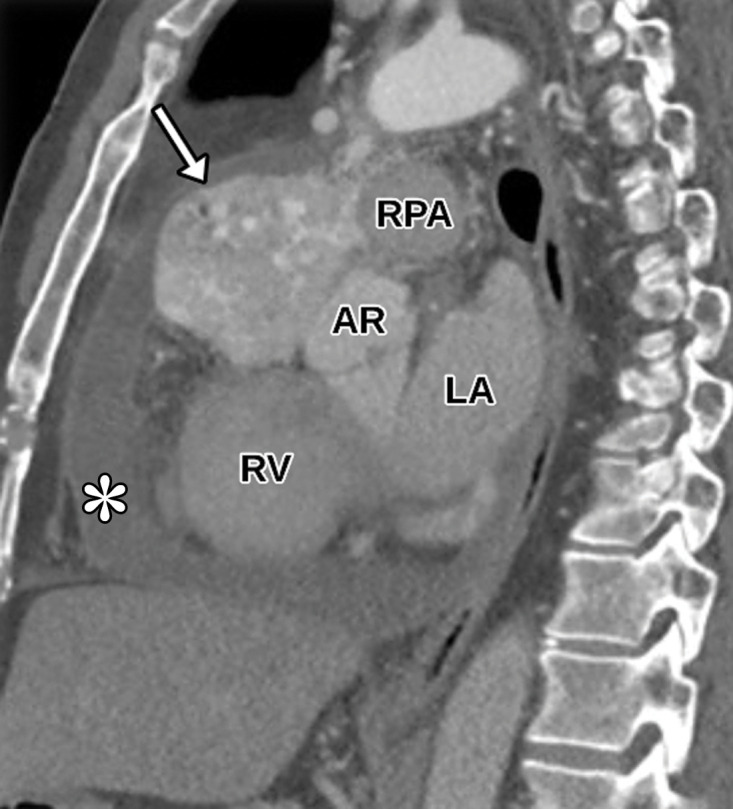 Anterior mediastinal mass. (a) Axial contrast-enhanced T1-weighted MR image shows a large avidly enhancing anterior mediastinal mass (arrow) with displacement of the heart secondary to mass effect. (b) Axial T2-weighted black-blood MR image shows the anterior mediastinal mass (arrow) with prominent internal hypointense flow voids. AR = aortic root, MPA = main pulmonary artery. (c, d) Axial (c) and sagittal (d) CTA images show the avidly enhancing anterior mediastinal mass (arrow) with an associated pericardial effusion (*). AR = aortic root, MPA in c = main pulmonary artery, RPA in d = right pulmonary artery. (e) Digital sub traction angiogram shows prominent contrast blush in the region of the mass (arrow) near the right coronary artery (arrowhead). (f) Parasternal long-axis TTE view retrospectively shows but incompletely characterizes the large anterior mediastinal mass (arrowhead), which is partially seen as a complex heterogeneous hypoechoic mass in the lateral aspect of the field of view. LVOT = LV outflow tract. Surgical biopsy yielded histologic findings consistent with a paraganglioma.