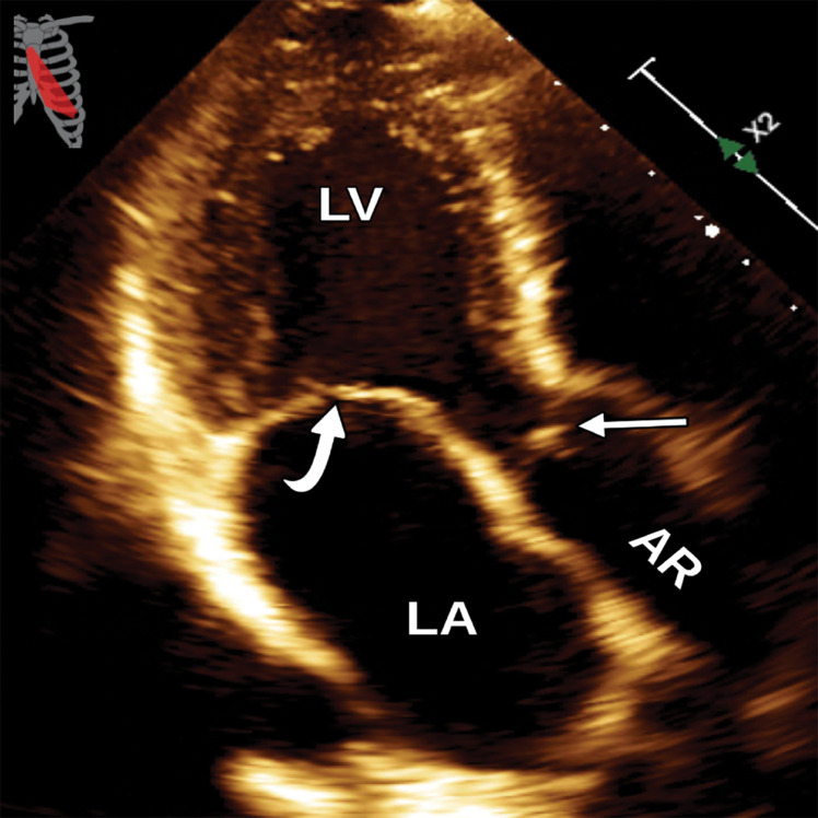 Normal apical three-chamber (long-axis) view at TTE (a) and correlative cardiac CTA (b). AR = aortic root, straight arrow = aortic valve, curved arrow = mitral valve.