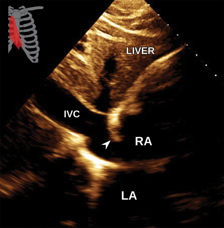 Normal subcostal inferior vena cava (IVC) view at TTE (a) and correlative cardiac CTA (b). Arrowhead = eustachian valve.