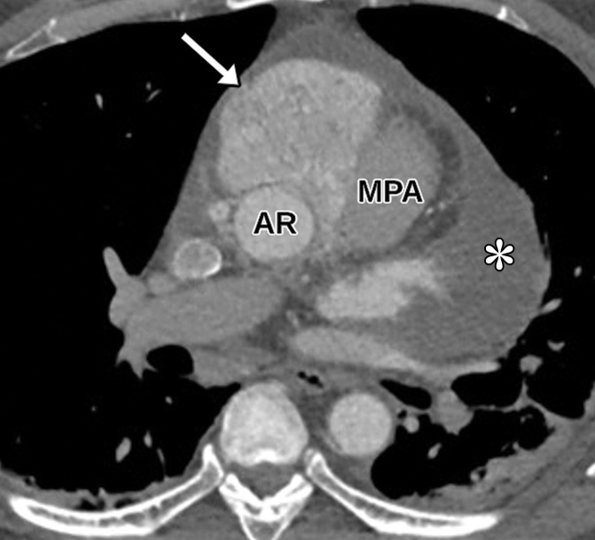 Anterior mediastinal mass. (a) Axial contrast-enhanced T1-weighted MR image shows a large avidly enhancing anterior mediastinal mass (arrow) with displacement of the heart secondary to mass effect. (b) Axial T2-weighted black-blood MR image shows the anterior mediastinal mass (arrow) with prominent internal hypointense flow voids. AR = aortic root, MPA = main pulmonary artery. (c, d) Axial (c) and sagittal (d) CTA images show the avidly enhancing anterior mediastinal mass (arrow) with an associated pericardial effusion (*). AR = aortic root, MPA in c = main pulmonary artery, RPA in d = right pulmonary artery. (e) Digital sub traction angiogram shows prominent contrast blush in the region of the mass (arrow) near the right coronary artery (arrowhead). (f) Parasternal long-axis TTE view retrospectively shows but incompletely characterizes the large anterior mediastinal mass (arrowhead), which is partially seen as a complex heterogeneous hypoechoic mass in the lateral aspect of the field of view. LVOT = LV outflow tract. Surgical biopsy yielded histologic findings consistent with a paraganglioma.