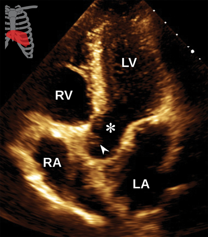Normal apical five-chamber view at TTE (a) and correlative cardiac CTA (b). Arrowhead = aortic valve, * = LV outflow tract.