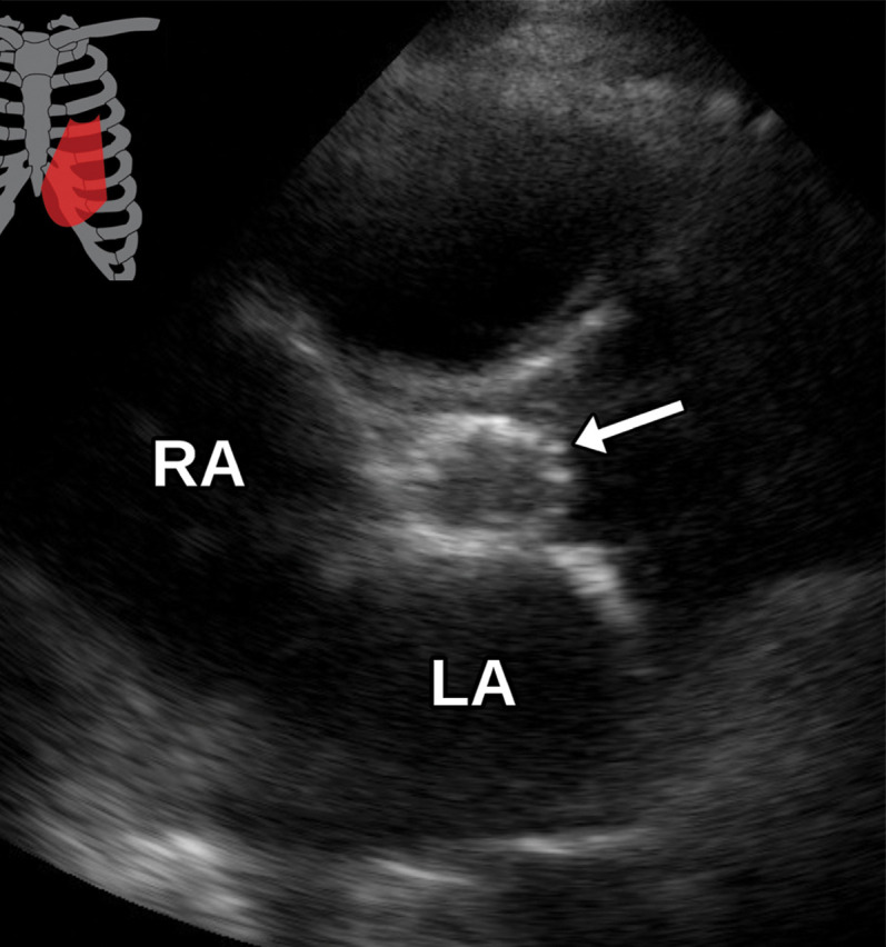 Hypoattenuating leaflet thickening (HALT) in a 62-year-old woman with a history significant for transcatheter aortic valve replacement (TAVR) secondary to aortic insufficiency. (a) Axial oblique CTA image of the aortic valve shows a metallic TAVR with appropriate positioning (arrowhead). The noncoronary leaflet is notably thickened with hypoattenuating material (arrow) present. (b, c) Parasternal short-axis (b) and long-axis (c) TTE views through the aortic valve show poor characterization of the valve prosthesis secondary to the echogenic nature of metal and posterior acoustic shadowing (arrow) without definite correlation with the CT finding. The patient had no clinical signs of infection and was subsequently diagnosed with HALT.