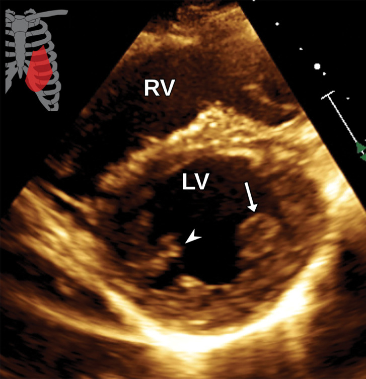 Normal parasternal short-axis view at the papillary muscle level at TTE (a) and correlative cardiac CTA (b). Arrow = anterolateral papillary muscle, arrowheads = posteromedial papillary muscle.