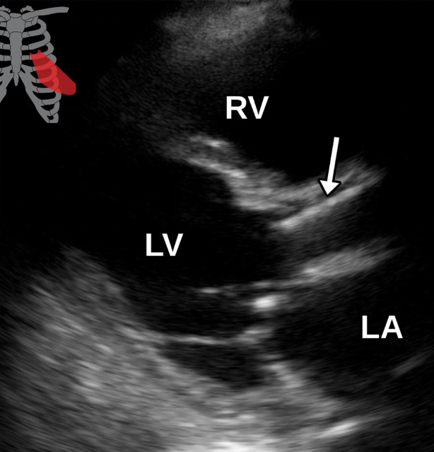 Hypoattenuating leaflet thickening (HALT) in a 62-year-old woman with a history significant for transcatheter aortic valve replacement (TAVR) secondary to aortic insufficiency. (a) Axial oblique CTA image of the aortic valve shows a metallic TAVR with appropriate positioning (arrowhead). The noncoronary leaflet is notably thickened with hypoattenuating material (arrow) present. (b, c) Parasternal short-axis (b) and long-axis (c) TTE views through the aortic valve show poor characterization of the valve prosthesis secondary to the echogenic nature of metal and posterior acoustic shadowing (arrow) without definite correlation with the CT finding. The patient had no clinical signs of infection and was subsequently diagnosed with HALT.