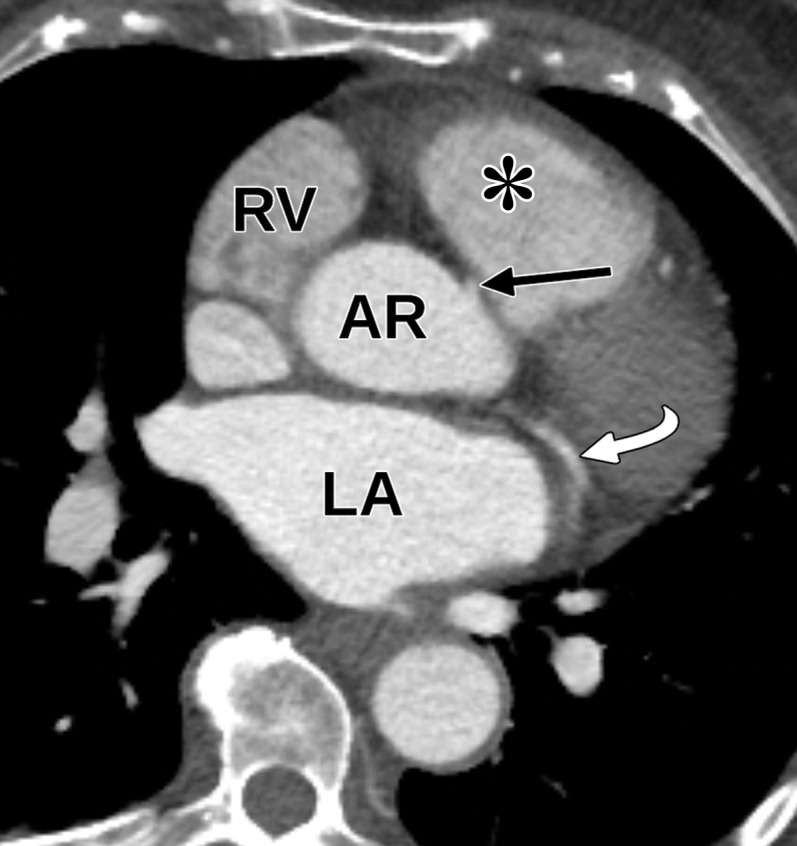 Anomalous coronary artery in a 63-year-old woman who underwent TTE for a 2-month history of chest pain. (a) Parasternal short-axis TTE image at the level of the aortic valve shows that the origins of the coronary arteries can be difficult to identify at TTE. The remainder of the TTE was notable only for borderline concentric LV hypertrophy and mild LA enlargement. LC = left coronary cusp, NC = noncoronary cusp, RC = right coronary cusp. (b, c) Reconstructed axial oblique (b) and volume-rendered (c) images from cardiac CTA of the coronary arteries show anomalous origin of the right coronary artery (straight arrow in b, RCA in c) from the left coronary cusp with an interarterial course. AR = aortic root, curved arrow in b = left main coronary artery, arrowhead in b = pulmonary valve, LAD in c = left anterior descending coronary artery, LCx in c = left circumflex coronary artery. (d, e) Selected images from subsequent nongated CTA of the chest, abdomen, and pelvis show the anomalous origin of the right coronary artery (black arrow in e) from the left coronary cusp. AR = aortic root, * = RV outflow tract, arrow in d = left main coronary artery, white arrow in e = left circumflex coronary artery. This case highlights the fact that anomalous coronary arteries may not be detected at TTE and are occasionally discovered at nongated chest CT.