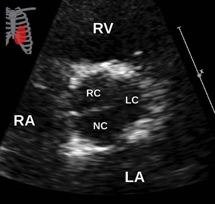 Anomalous coronary artery in a 63-year-old woman who underwent TTE for a 2-month history of chest pain. (a) Parasternal short-axis TTE image at the level of the aortic valve shows that the origins of the coronary arteries can be difficult to identify at TTE. The remainder of the TTE was notable only for borderline concentric LV hypertrophy and mild LA enlargement. LC = left coronary cusp, NC = noncoronary cusp, RC = right coronary cusp. (b, c) Reconstructed axial oblique (b) and volume-rendered (c) images from cardiac CTA of the coronary arteries show anomalous origin of the right coronary artery (straight arrow in b, RCA in c) from the left coronary cusp with an interarterial course. AR = aortic root, curved arrow in b = left main coronary artery, arrowhead in b = pulmonary valve, LAD in c = left anterior descending coronary artery, LCx in c = left circumflex coronary artery. (d, e) Selected images from subsequent nongated CTA of the chest, abdomen, and pelvis show the anomalous origin of the right coronary artery (black arrow in e) from the left coronary cusp. AR = aortic root, * = RV outflow tract, arrow in d = left main coronary artery, white arrow in e = left circumflex coronary artery. This case highlights the fact that anomalous coronary arteries may not be detected at TTE and are occasionally discovered at nongated chest CT.