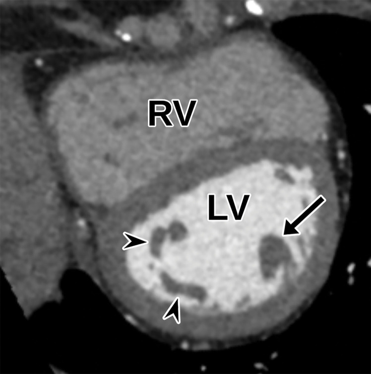 Normal parasternal short-axis view at the papillary muscle level at TTE (a) and correlative cardiac CTA (b). Arrow = anterolateral papillary muscle, arrowheads = posteromedial papillary muscle.