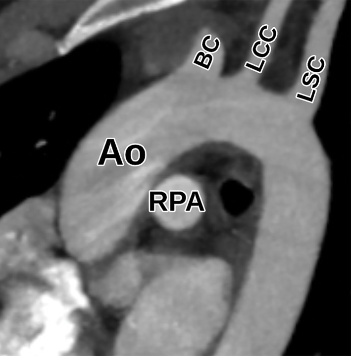 Normal suprasternal long-axis view at TTE (a) and correlative cardiac CTA (b). Ao = aorta, BC = brachiocephalic artery, LCC = left common carotid artery, LSC = left subclavian artery, RPA = right pulmonary artery.