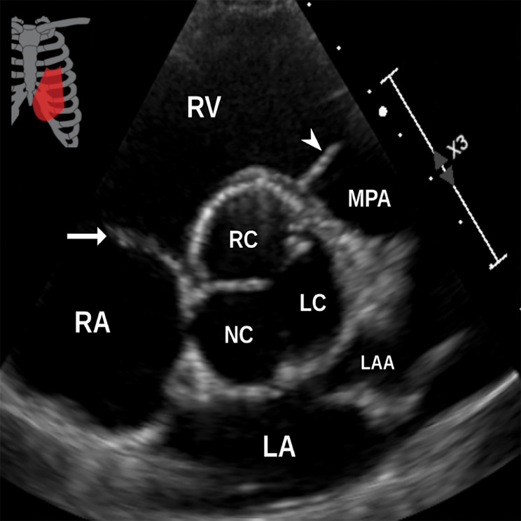 Normal parasternal short-axis view at the aortic valve level at TTE (a) and correlative cardiac CTA (b). LAA = left atrial appendage, LC = left coronary cusp, MPA = main pulmonary artery, NC = noncoronary cusp, RC = right coronary cusp, arrow = tricuspid valve, arrowhead = pulmonary valve.