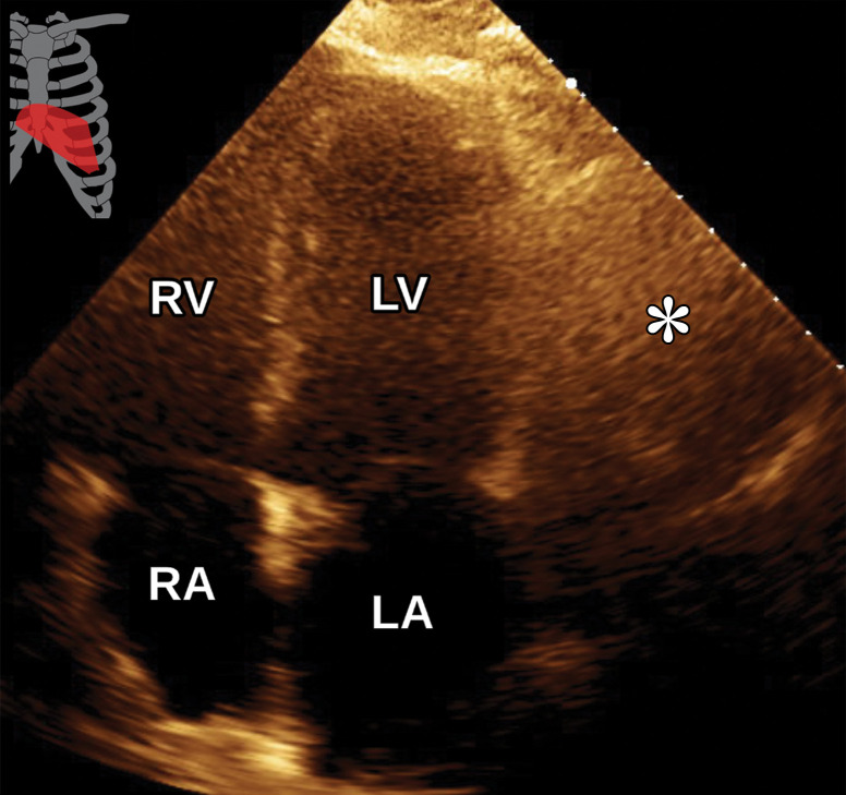 Extracardiac mass in an 81-year-old man who presented to the emergency department with acute chest pain and underwent CT pulmonary angiography (CTPA). (a) Axial CTPA image shows a large heterogeneous mass (*) in the left upper lobe that abuts and invades the pericardium, as well as a moderate-sized left-sided pleural effusion (arrowhead) and adjacent atelectasis. (b) Apical four-chamber view from TTE performed 2 weeks earlier shows the large hypoechoic mass (*) adjacent to the LV; the mass was seen only in retrospect. CT-guided biopsy demonstrated primary lung squamous cell carcinoma.