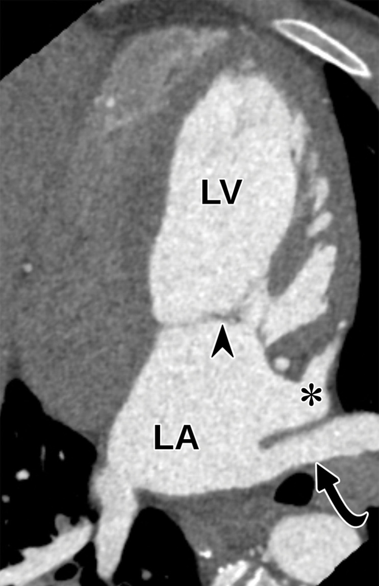 Normal apical two-chamber view at TTE (a) and correlative cardiac CTA (b). Arrowhead = mitral valve, * =