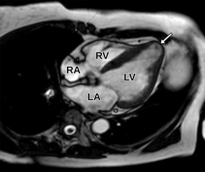 Apical aneurysm in a 69-year-old man with a history of coronary artery disease and prior myocardial infarction. (a) Axial steady-state free-precession (SSFP) MR image shows apical myocardial thinning and ballooning (arrow), consistent with an LV apical aneurysm. (b) Apical two-chamber TTE view obtained 2 days later shows no definite apical aneurysm or thinning (arrow).
