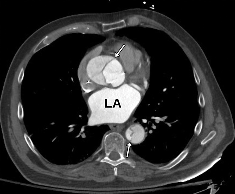 Aortic dissection in a 71-year-old man with a medical history significant for hypertension who presented to the emergency department (ED) with severe acute back pain. (a) Axial CTA image of the aorta shows an aortic dissection involving the aortic root and descending aorta (arrows) with extension to the large branch vessels (not shown). (b) Parasternal long-axis TTE view obtained earlier in the ED shows no gross abnormality. In particular, there is no dissection flap identified in the aortic root (arrow). LVOT = LV outflow tract.