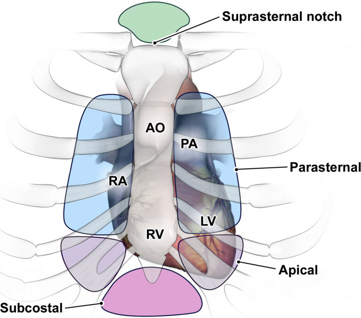 Standard echocardiographic windows in transthoracic echocardiography (TTE). The four standard windows are parasternal, apical, subcostal, and suprasternal. The parasternal and apical windows are generally used from the left side. The third or fourth intercostal space is most often used for the parasternal window, and the fifth intercostal space is most often used for the apical window. AO = aorta, LV = left ventricle, PA = pulmonary artery, RA = right atrium, RV = right ventricle. (Reprinted, with permission, from reference 9.)