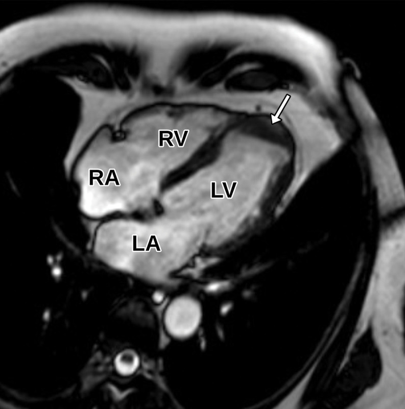 Apical thrombus in an 81-year-old man with a history of coronary artery disease and prior myocardial infarction. (a) Axial SSFP MR image shows a flat hypointensity (arrow) in an otherwise morphologically normal LV. (b) Apical two-chamber TTE view obtained 1 day earlier shows a questionable area of hyperechogenicity (arrow) near the LV apex, without a definite apical thrombus visualized.