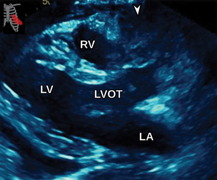 Anterior mediastinal mass. (a) Axial contrast-enhanced T1-weighted MR image shows a large avidly enhancing anterior mediastinal mass (arrow) with displacement of the heart secondary to mass effect. (b) Axial T2-weighted black-blood MR image shows the anterior mediastinal mass (arrow) with prominent internal hypointense flow voids. AR = aortic root, MPA = main pulmonary artery. (c, d) Axial (c) and sagittal (d) CTA images show the avidly enhancing anterior mediastinal mass (arrow) with an associated pericardial effusion (*). AR = aortic root, MPA in c = main pulmonary artery, RPA in d = right pulmonary artery. (e) Digital sub traction angiogram shows prominent contrast blush in the region of the mass (arrow) near the right coronary artery (arrowhead). (f) Parasternal long-axis TTE view retrospectively shows but incompletely characterizes the large anterior mediastinal mass (arrowhead), which is partially seen as a complex heterogeneous hypoechoic mass in the lateral aspect of the field of view. LVOT = LV outflow tract. Surgical biopsy yielded histologic findings consistent with a paraganglioma.