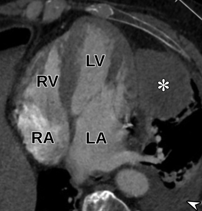 Extracardiac mass in an 81-year-old man who presented to the emergency department with acute chest pain and underwent CT pulmonary angiography (CTPA). (a) Axial CTPA image shows a large heterogeneous mass (*) in the left upper lobe that abuts and invades the pericardium, as well as a moderate-sized left-sided pleural effusion (arrowhead) and adjacent atelectasis. (b) Apical four-chamber view from TTE performed 2 weeks earlier shows the large hypoechoic mass (*) adjacent to the LV; the mass was seen only in retrospect. CT-guided biopsy demonstrated primary lung squamous cell carcinoma.