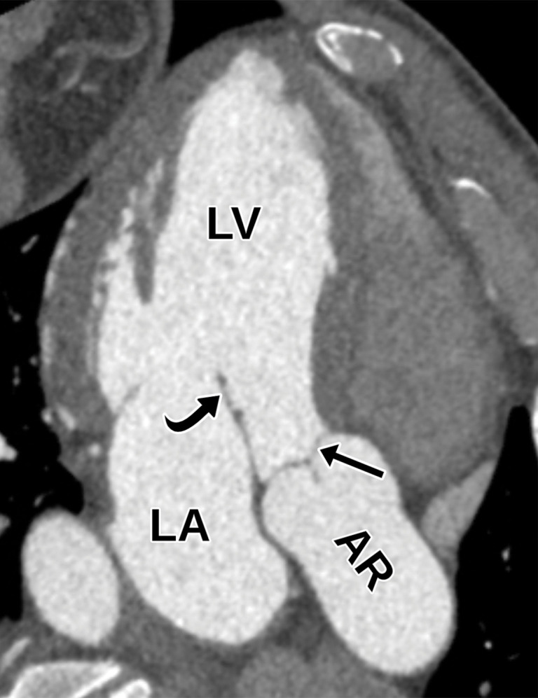 Normal apical three-chamber (long-axis) view at TTE (a) and correlative cardiac CTA (b). AR = aortic root, straight arrow = aortic valve, curved arrow = mitral valve.