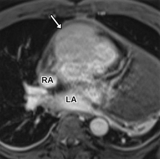 Anterior mediastinal mass. (a) Axial contrast-enhanced T1-weighted MR image shows a large avidly enhancing anterior mediastinal mass (arrow) with displacement of the heart secondary to mass effect. (b) Axial T2-weighted black-blood MR image shows the anterior mediastinal mass (arrow) with prominent internal hypointense flow voids. AR = aortic root, MPA = main pulmonary artery. (c, d) Axial (c) and sagittal (d) CTA images show the avidly enhancing anterior mediastinal mass (arrow) with an associated pericardial effusion (*). AR = aortic root, MPA in c = main pulmonary artery, RPA in d = right pulmonary artery. (e) Digital sub traction angiogram shows prominent contrast blush in the region of the mass (arrow) near the right coronary artery (arrowhead). (f) Parasternal long-axis TTE view retrospectively shows but incompletely characterizes the large anterior mediastinal mass (arrowhead), which is partially seen as a complex heterogeneous hypoechoic mass in the lateral aspect of the field of view. LVOT = LV outflow tract. Surgical biopsy yielded histologic findings consistent with a paraganglioma.