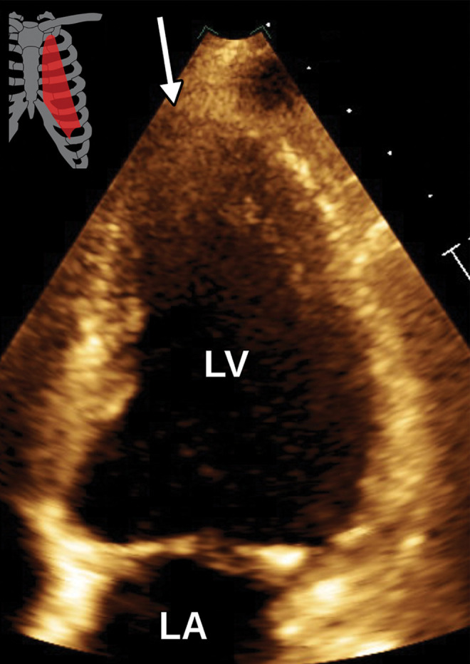 Apical aneurysm in a 69-year-old man with a history of coronary artery disease and prior myocardial infarction. (a) Axial steady-state free-precession (SSFP) MR image shows apical myocardial thinning and ballooning (arrow), consistent with an LV apical aneurysm. (b) Apical two-chamber TTE view obtained 2 days later shows no definite apical aneurysm or thinning (arrow).