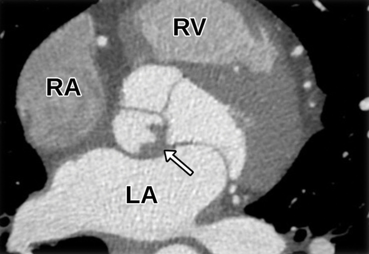 Aortic valve vegetation in a 58-year-old man with septicemia and a history of prior septic emboli to the brain. (a) Axial CTA image of the aortic valve shows an irregular vegetation of the noncoronary cusp (arrow). (b) Sagittal oblique (three-chamber) white-blood SSFP MR image shows the irregular vegetation involving the noncoronary cusp (arrow). AR = aortic root. (c, d) Parasternal long-axis (c) and short-axis (d) TTE views through the level of the aortic valve (arrow in c, AV in d) show normal-appearing leaflets without definite thickening or vegetation. The imaging findings in this clinical setting are consistent with infective endocarditis. LVOT in c = LV outflow tract.