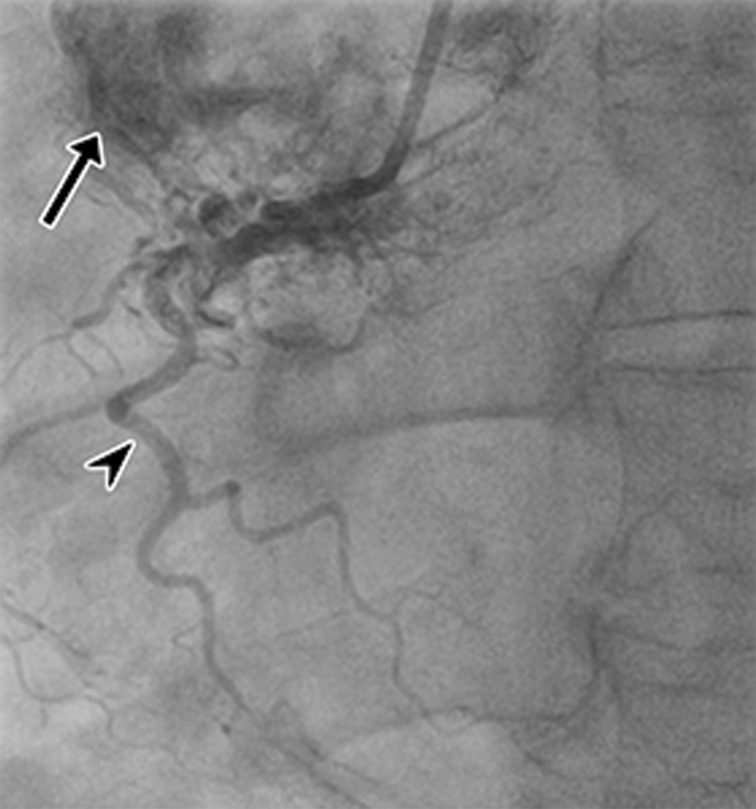 Anterior mediastinal mass. (a) Axial contrast-enhanced T1-weighted MR image shows a large avidly enhancing anterior mediastinal mass (arrow) with displacement of the heart secondary to mass effect. (b) Axial T2-weighted black-blood MR image shows the anterior mediastinal mass (arrow) with prominent internal hypointense flow voids. AR = aortic root, MPA = main pulmonary artery. (c, d) Axial (c) and sagittal (d) CTA images show the avidly enhancing anterior mediastinal mass (arrow) with an associated pericardial effusion (*). AR = aortic root, MPA in c = main pulmonary artery, RPA in d = right pulmonary artery. (e) Digital sub traction angiogram shows prominent contrast blush in the region of the mass (arrow) near the right coronary artery (arrowhead). (f) Parasternal long-axis TTE view retrospectively shows but incompletely characterizes the large anterior mediastinal mass (arrowhead), which is partially seen as a complex heterogeneous hypoechoic mass in the lateral aspect of the field of view. LVOT = LV outflow tract. Surgical biopsy yielded histologic findings consistent with a paraganglioma.