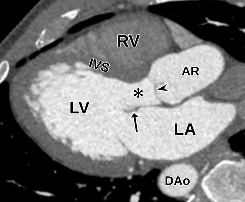 Normal parasternal long-axis LV view at TTE (a) and correlative cardiac CT angiography (CTA) (b). AR = aortic root, DAo = descending aorta, IVS = interventricular septum, LA = left atrium, arrow = mitral valve, arrowhead = aortic valve, * = LV outflow tract.